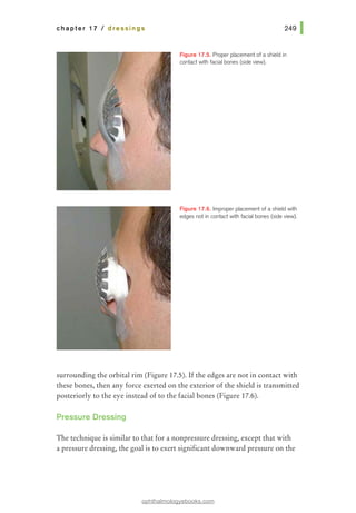 chapter 17 I dressings
Figure 17.5. Proper placement of ashield in
contact with facial bones (side view).
Figure 17.6. Improperplacement of ashield with
edges not in contact with facial bones (side view).
surrounding the orbital rim (Figure 17.5). Ifthe edges are not in contact with
these bones, then any force exerted on the exterior of the shield is transmitted
posteriorly to the eye instead of to the facial bones (Figure 17.6).
Pressure Dressing
The technique is similar to that for a nonpressure dressing, except that with
a pressure dressing, the goal is to exert significant downward pressure on the
ophthalmologyebooks.com
 