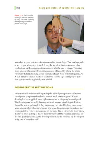 Figure 17.7. Technique for
creating a pressure dressing
by lifting the cheek superiorly
before placing the inferior
portion of the 1ape.
basic pri nci pies of ophthalmic surgery
wound to prevent postoperative edema and/or hemorrhage. Two oval eye pads
or an eye pad with gauze is used. It may be useful to have an assistant place
gentle downward pressure on the dressing while the tape is placed. The maxi-
mum amount ofpressure from the dressing is obtained by lifting the cheek
superiorly before attaching the inferior end of each piece of tape (Figure 17.7).
A skin adhesive such as Mastisol can help to seal the tape in the proper posi-
tion. An eye shield is generally not needed.
POSTOPERATIVE INSTRUCTIONS
Patients should be instructed regarding the normal postoperative course and
any signs or symptoms that should prompt a call to the surgeon. When a
dressing has been applied, some tightness and/or itching may be anticipated.
The dressing may normally become wet with tears or blood-tinged. Patients
should be instructed to call if they experience excessive bleeding, pain, an un-
usual amount of swelling or bruising, or a fever. In some cases, the patient may
be instructed to remove the dressing on the same day as surgery. In other cases,
it is left in place as long as 2 days postoperatively. If the patient is examined on
the first postoperative day, the dressing will usually be removed by the surgeon
or by one of the office staff.
 