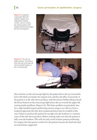 Figure 4.2. Outpatient
surgical bed. Bed wittl
sepa.ra1e headrest and
independent headrest
controls. Lever A controls
the vertical position of the
headrest and lever B changes
the tilt of the headrest.
Figure 4.3. The chin-up
patient position. This posture
drives the eye to the lower lid
when the patient fixates on
the microscope light.
basic prl ncl pies of ophthalmic surgery
floor, fixation on the microscope light by the patient drives the eye toward the
lower lid which can hinder the surgical view and the red reflex. Conversely, if
the patient is in the chin-down position, with the inferior limbus tilting toward
the floor, fixation on the microscope light drives the eye toward the upper lid,
causing similar problems (Figure 4.4). This latter problem is particularly true
for a right-handed surgeon performing cataract surgery on a left eye from a
temporal approach; the chin-down patient position must be avoided in this
case. Failure to position the patient far enough onto the headrest is a common
cause of the chin-down position. Before starting, make sure that the patient is
fully onto the headrest. This will not only result in better patient positioning
for surgery, but also greater comfort for the patient, because the head and neck
are much better supported.
 