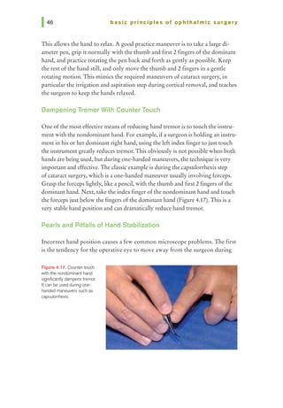 basic prl ncl pies of ophthalmic surgery
This allows the hand to relax. A good practice maneuver is to take a large di-
ameter pen, grip it normally with the thumb and first 2 fmgers ofthe dominant
hand, and practice rotating the pen back and forth as gently as possible. Keep
the rest of the hand still, and only move the thumb and 2 fingers in a gentle
rotating motion. This mimics the required maneuvers of cataract surgery, in
particular the irrigation and aspiration step during cortical removal, and teaches
the surgeon to keep the hands relaxed.
Dampening Tremor With Counter Touch
One ofthe most effective means of reducing hand tremor is to touch the instru-
ment with the nondominant hand. For example, ifa surgeon is holding an instru-
ment in his orher dominant right hand, using the left index finger to just touch
the instrument gready reduces tremor. This obviously is not possible when both
hands are being used, but during one-handed maneuvers, the technique is very
important and effective. The classic example is during the capsulorrhexis step
of cataract surgery, which is a one-handed maneuver usually involving forceps.
Grasp the forceps lighdy, like a pencil, with the thumb and first 2 fingers ofthe
dominant hand. Next, take the index finger of the nondominant hand and touch
the forceps just below the fingers ofthe dominant hand (Figure 4.17). This is a
very stable hand position and can dramatically reduce hand tremor.
Pearls and Pitfalls of Hand Stabilization
Incorrect hand position causes a few common microscope problems. The first
is the tendency for the operative eye to move away from the surgeon during
Figure 4.17. Counter touch
with the nondominant hand
significantly dampens tremor.
Itcan be used during one-
handed maneuvers such as
capsulormexis.
 