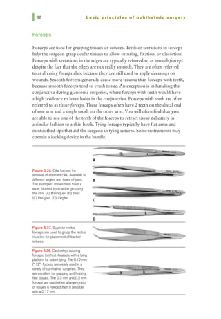 basic principles of ophthalmic surgery
Forceps
Forceps are used for grasping tissues or sutures. Teeth or serrations in forceps
help the surgeon grasp ocular tissues to allow suturing, fixatio~ or dissection.
Forceps with serrations in the edges are typically referred to as smooth forceps
despite the fact that the edges are not really smooth. They are often referred
to as dressingforceps also, because they are still used to apply dressings on
wounds. Smooth forceps generally cause more trauma than forceps with teeth,
because smooth forceps tend to crush tissue. An exception is in handling the
conjunctiva during glaucoma surgeries, where forceps with teeth would have
a high tendency to leave holes in the conjunctiva. Forceps with teeth are often
referred to as tissue forceps. These forceps often have 2 teeth on the distal end
of one arm and a single tooth on the other arm. You will often find that you
are able to use one ofthe teeth ofthe forceps to retract tissue delicately in
a similar fashion to a skin hook. Tying forceps typically have flat arms and
nontoothed tips that aid the surgeon in tying sutures. Some instruments may
contain a locking device in the handle.
Figure 5.28. Cilia forceps for
removal of aberrant cilia. Available in
different angles and types ofjaws.
The examples shown here have a
wide, blunted tip to aid in grouping
the cilia. (A) Barraquer. (B) Beer.
(C) Douglas. (D) Ziegler.
Figure 5.27. Superior rectus
forceps are used to grasp the rectus
muscles for placement of traction
sutures.
Figure 5.28. Ca.stroviejo suturing
forceps, toothed. Availablewith a tying
platform forsuturetying. The 0.12 mm
(".12") fort:eps are widely used in a
variety of ophthalmic surgeries. They
are excellentforgrasping and holding
fine tissues. The 0.3 mm and 0.5 mm
forceps are used when a largergrasp
of tissues is needed than is possible
with a0.12 mm.
A
B
D
 