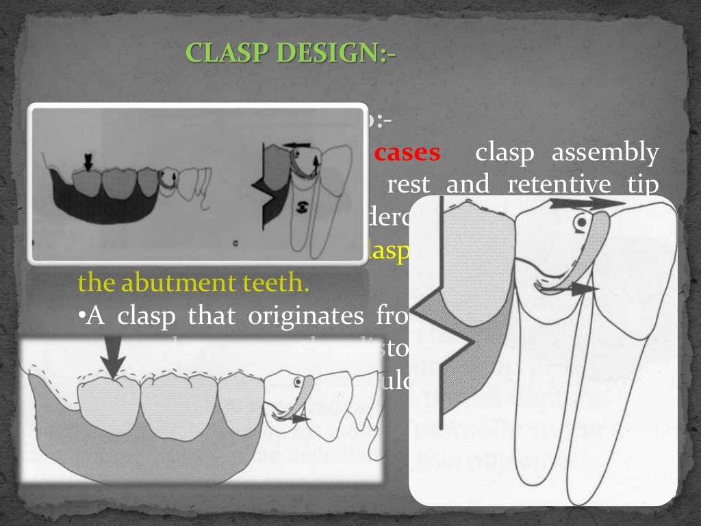 Basic principles of removable partial denture design copy