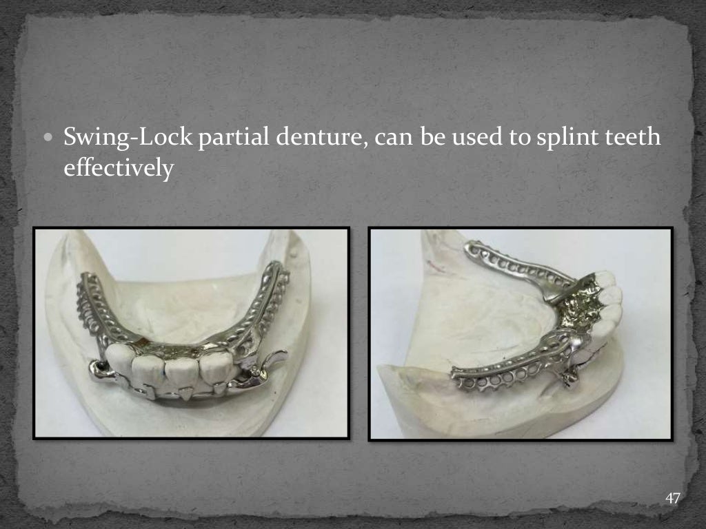 Basic principles of removable partial denture design copy