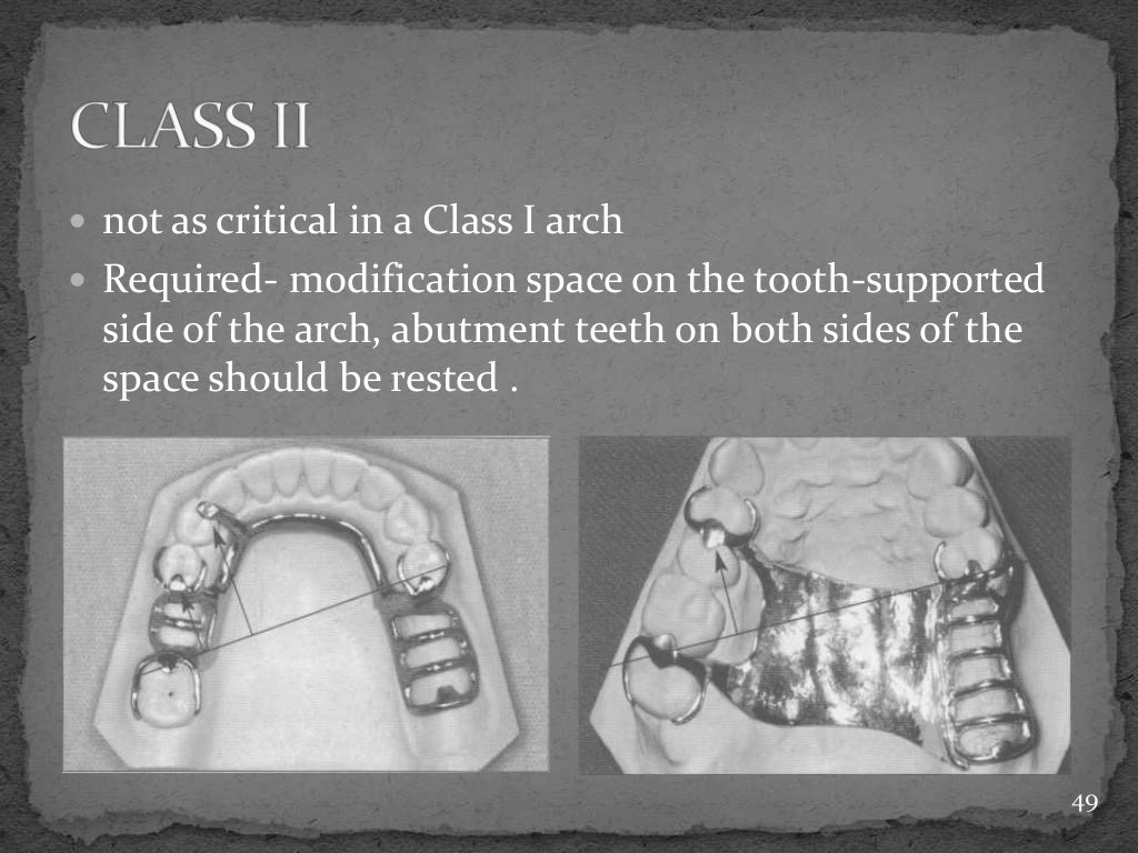 Basic principles of removable partial denture design copy