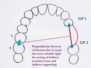 basic_principles_of_removable_partial_denture_design_-_copy.ppt