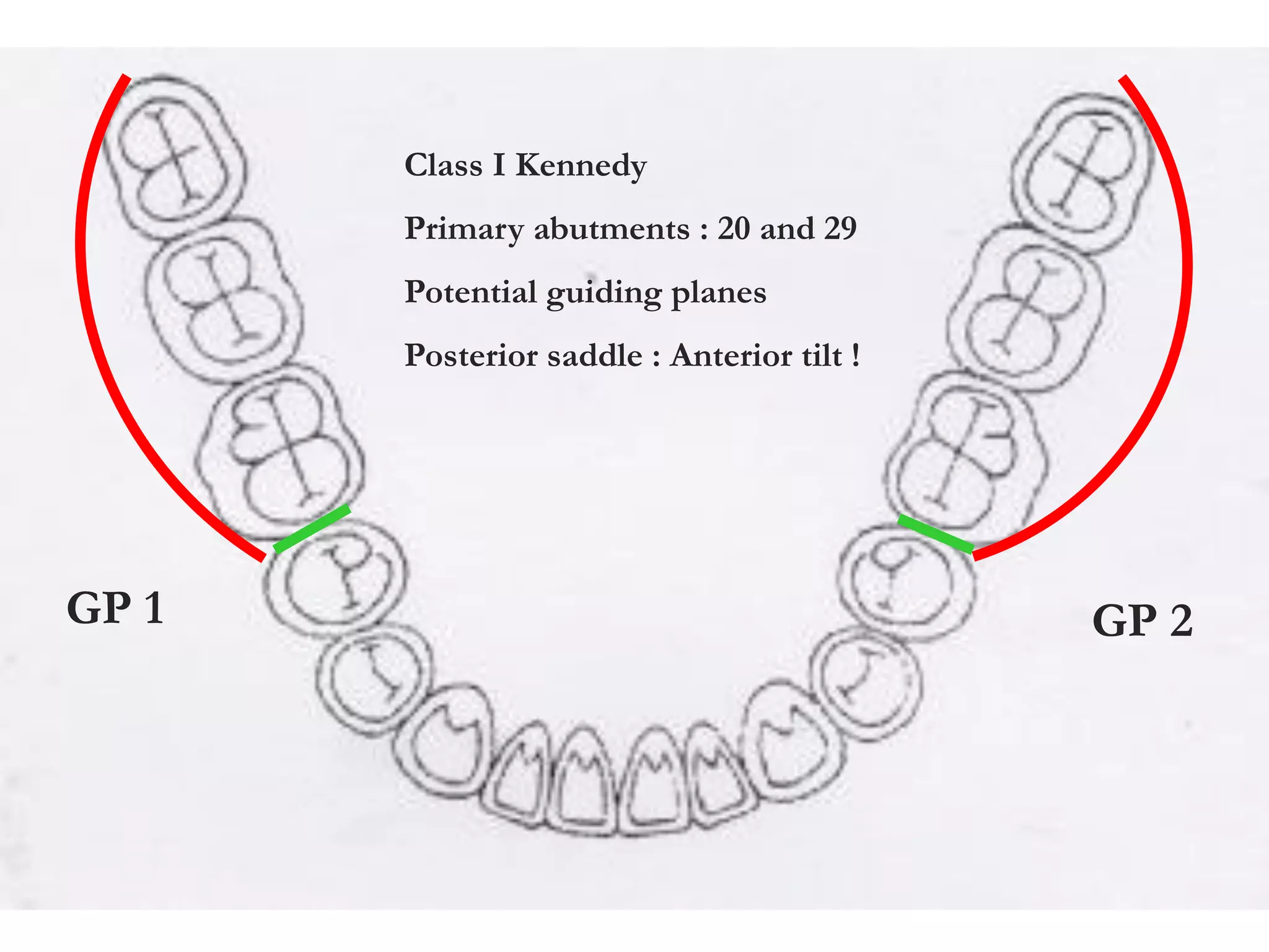 Class I Kennedy
Primary abutments : 20 and 29
Potential guiding planes
Posterior saddle : Anterior tilt !
GP 1 GP 2
 