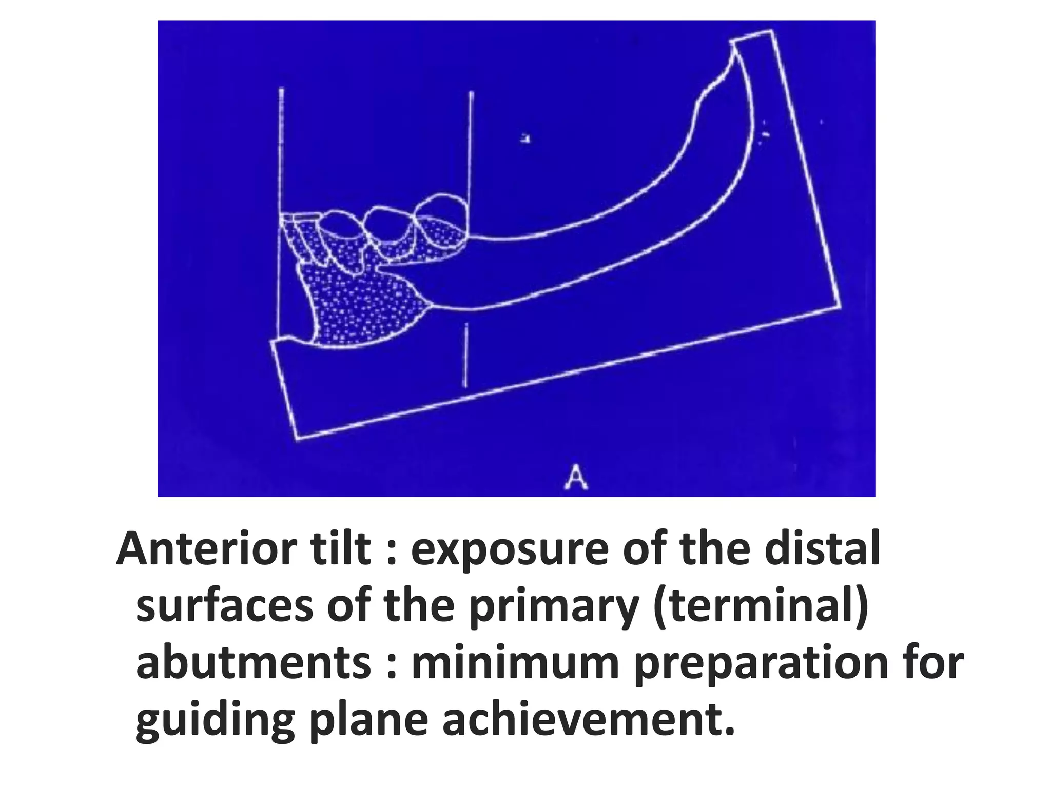 Anterior tilt : exposure of the distal
surfaces of the primary (terminal)
abutments : minimum preparation for
guiding plane achievement.
 