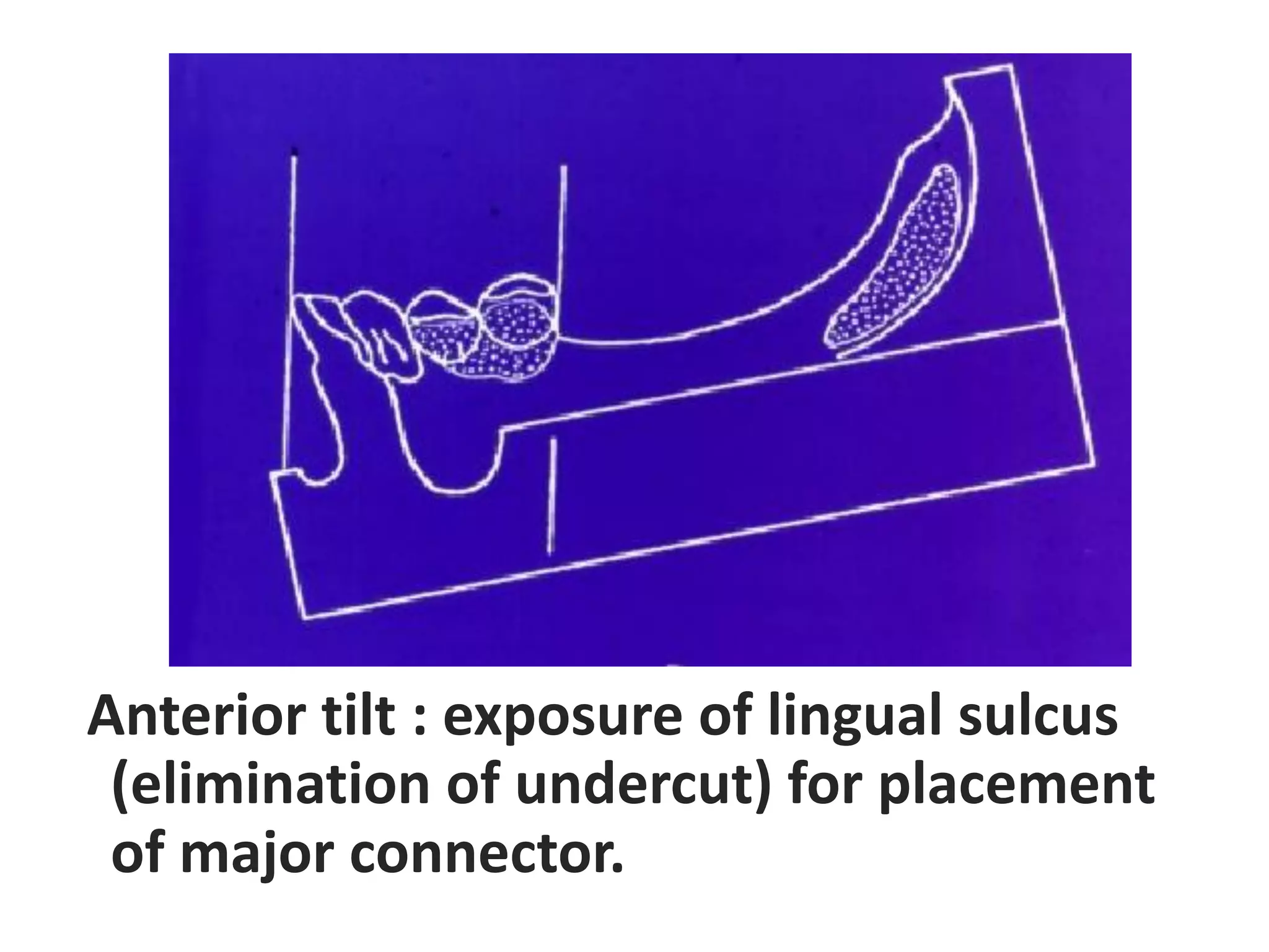 Anterior tilt : exposure of lingual sulcus
(elimination of undercut) for placement
of major connector.
 
