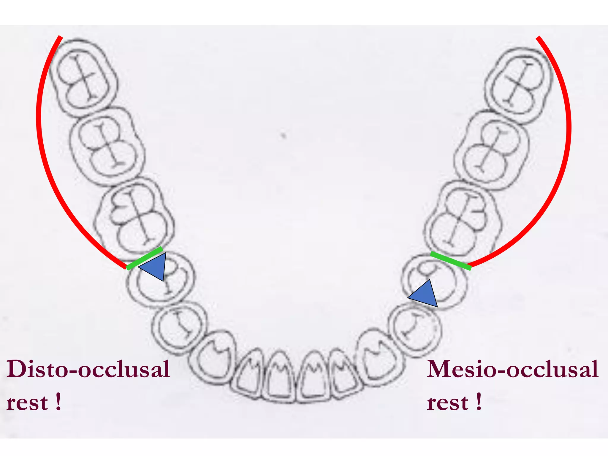 Mesio-occlusal
rest !
Disto-occlusal
rest !
 