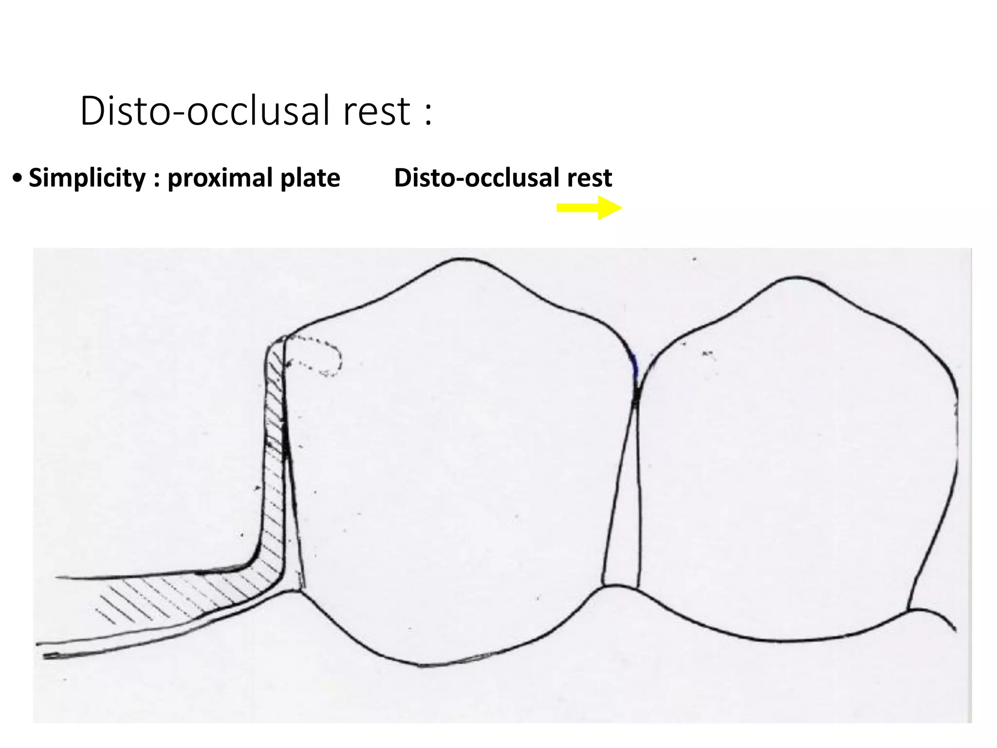Disto-occlusal rest :
•Simplicity : proximal plate Disto-occlusal rest
 