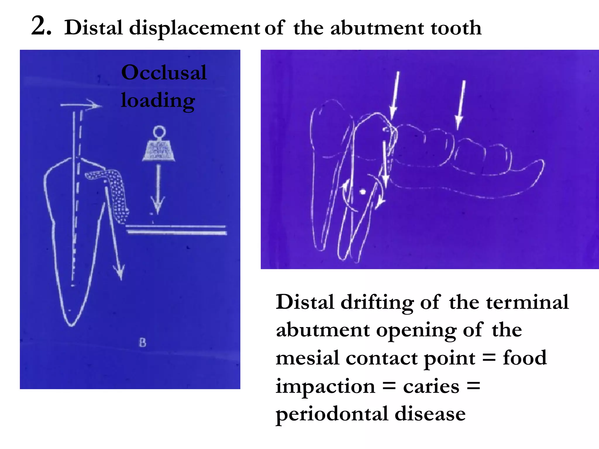 Distal drifting of the terminal
abutment opening of the
mesial contact point = food
impaction = caries =
periodontal disease
Occlusal
loading
2. Distal displacement of the abutment tooth
 