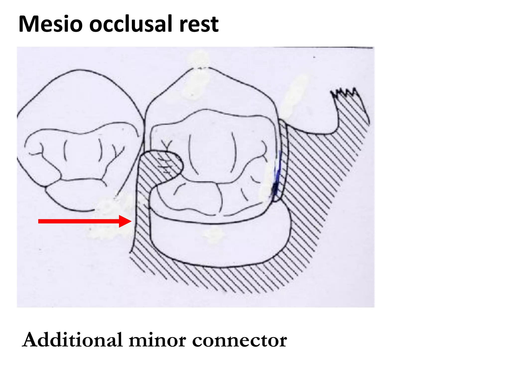 Mesio occlusal rest
Additional minor connector
 