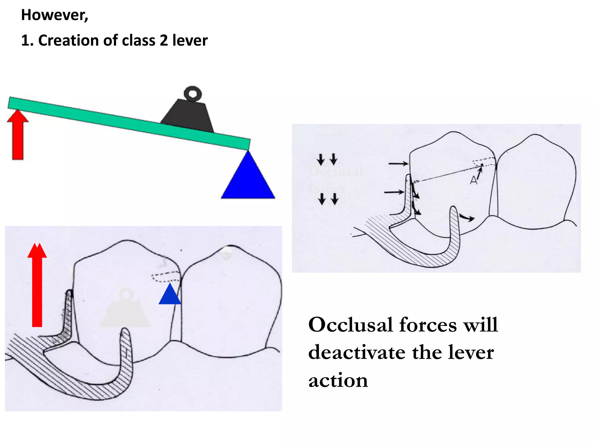However,
1. Creation of class 2 lever
Occlusal
forces
Occlusal forces will
deactivate the lever
action
 