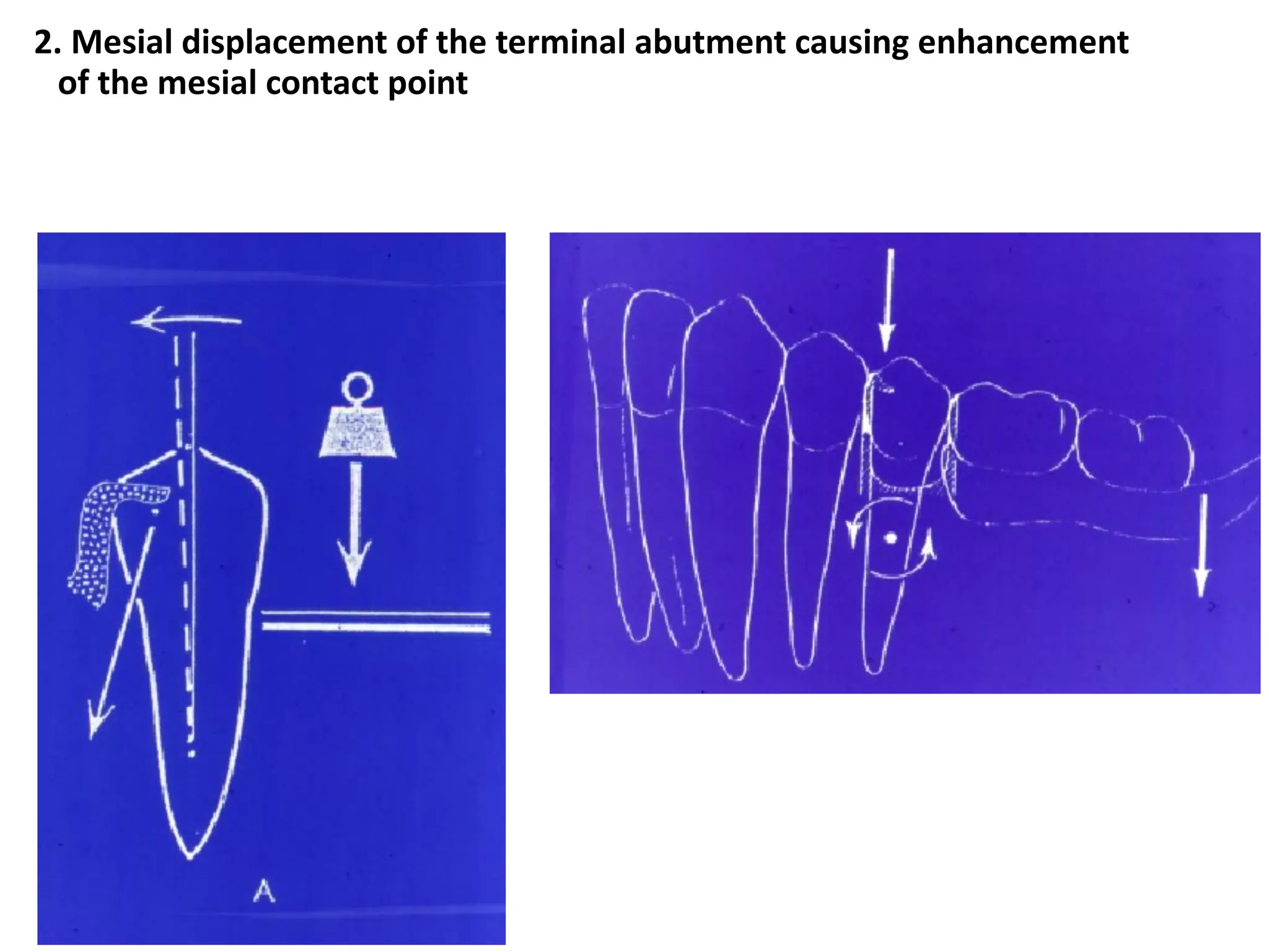 2. Mesial displacement of the terminal abutment causing enhancement
of the mesial contact point
 