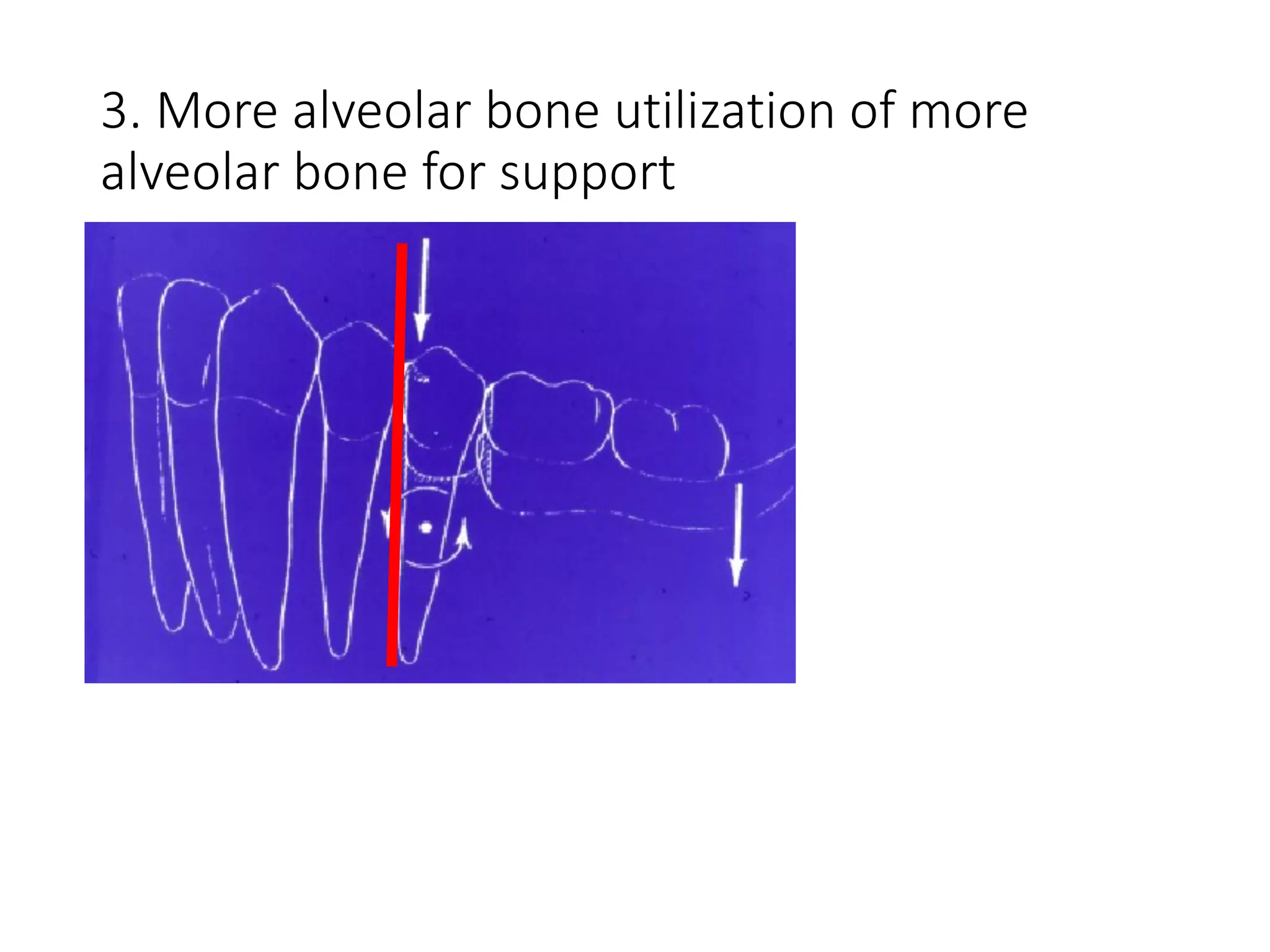 3. More alveolar bone utilization of more
alveolar bone for support
 
