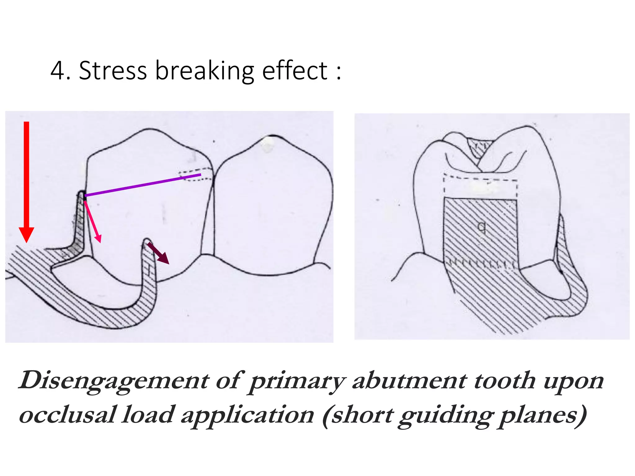 4. Stress breaking effect :
Disengagement of primary abutment tooth upon
occlusal load application (short guiding planes)
 