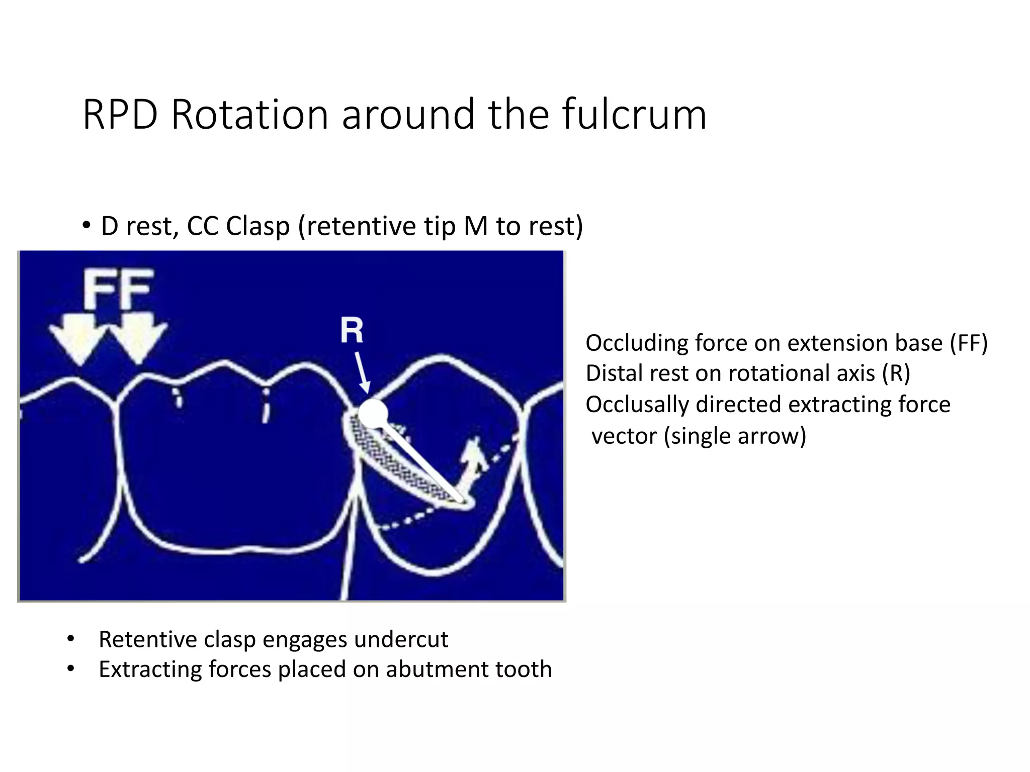 RPD Rotation around the fulcrum
• D rest, CC Clasp (retentive tip M to rest)
Occluding force on extension base (FF)
Distal rest on rotational axis (R)
Occlusally directed extracting force
vector (single arrow)
• Retentive clasp engages undercut
• Extracting forces placed on abutment tooth
 
