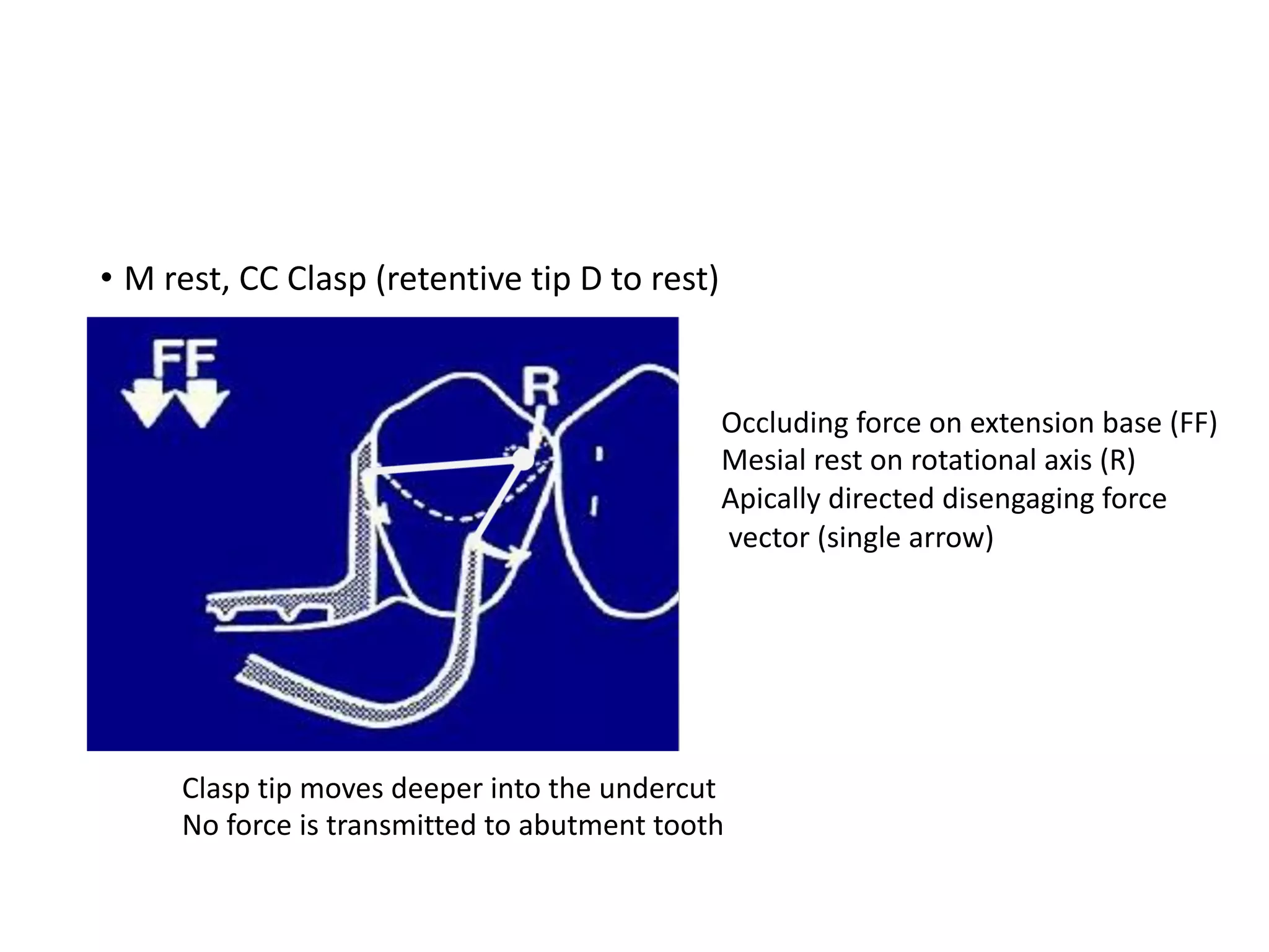 • M rest, CC Clasp (retentive tip D to rest)
Occluding force on extension base (FF)
Mesial rest on rotational axis (R)
Apically directed disengaging force
vector (single arrow)
Clasp tip moves deeper into the undercut
No force is transmitted to abutment tooth
 