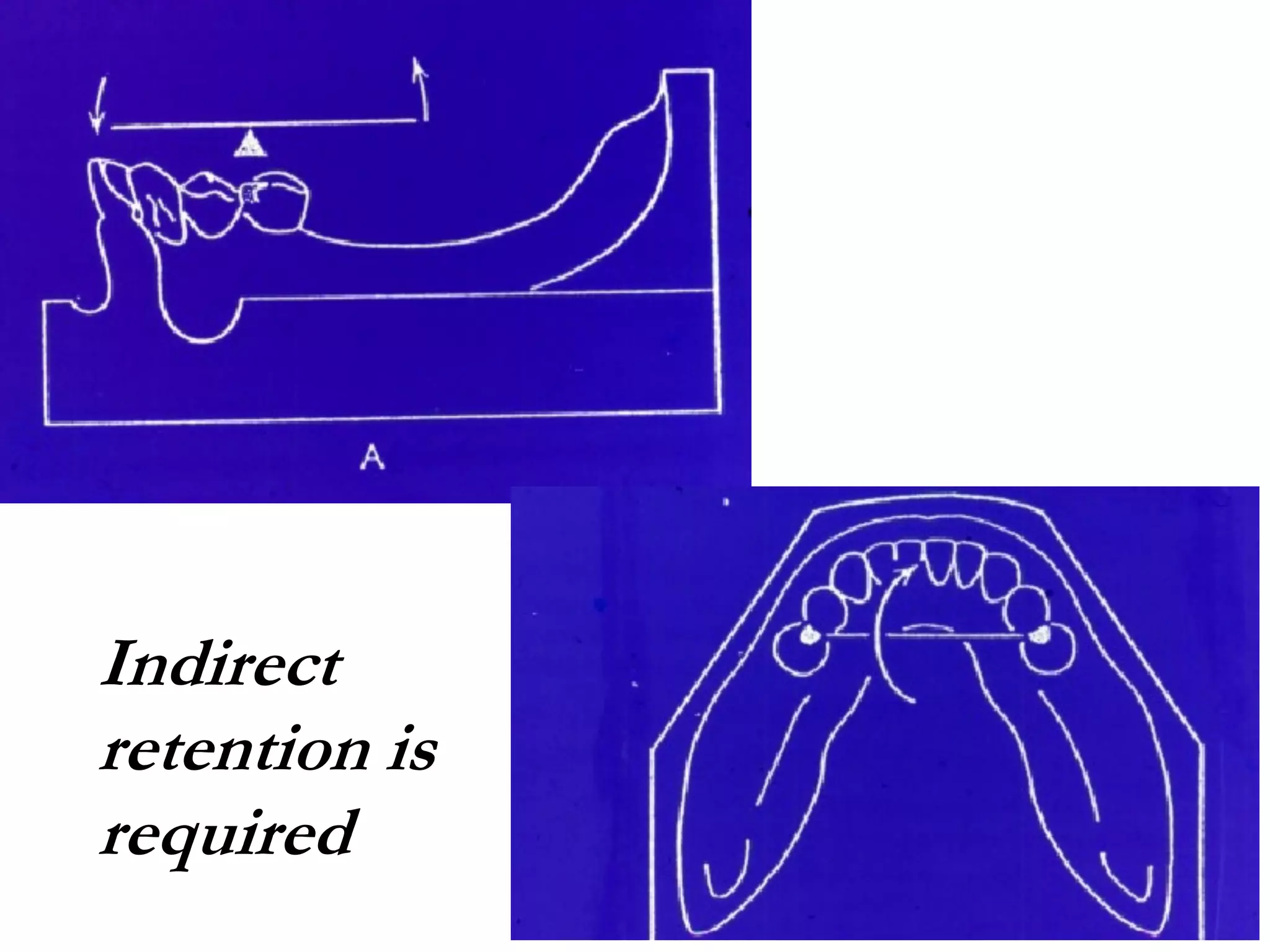 Indirect
retention is
required
 