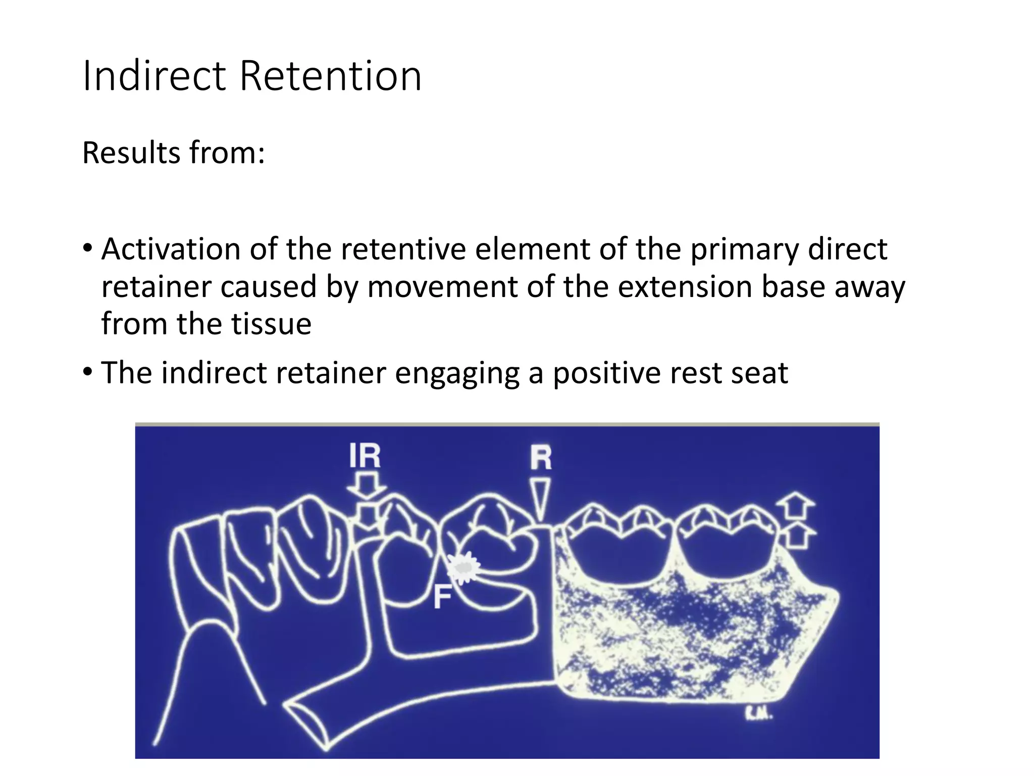 Indirect Retention
Results from:
• Activation of the retentive element of the primary direct
retainer caused by movement of the extension base away
from the tissue
• The indirect retainer engaging a positive rest seat
 
