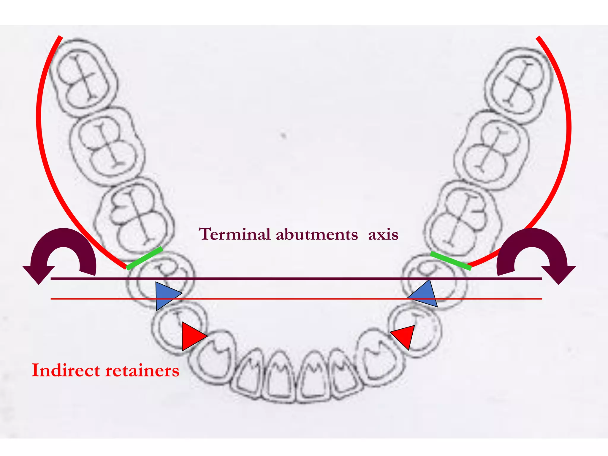Terminal abutments axis
Indirect retainers
 