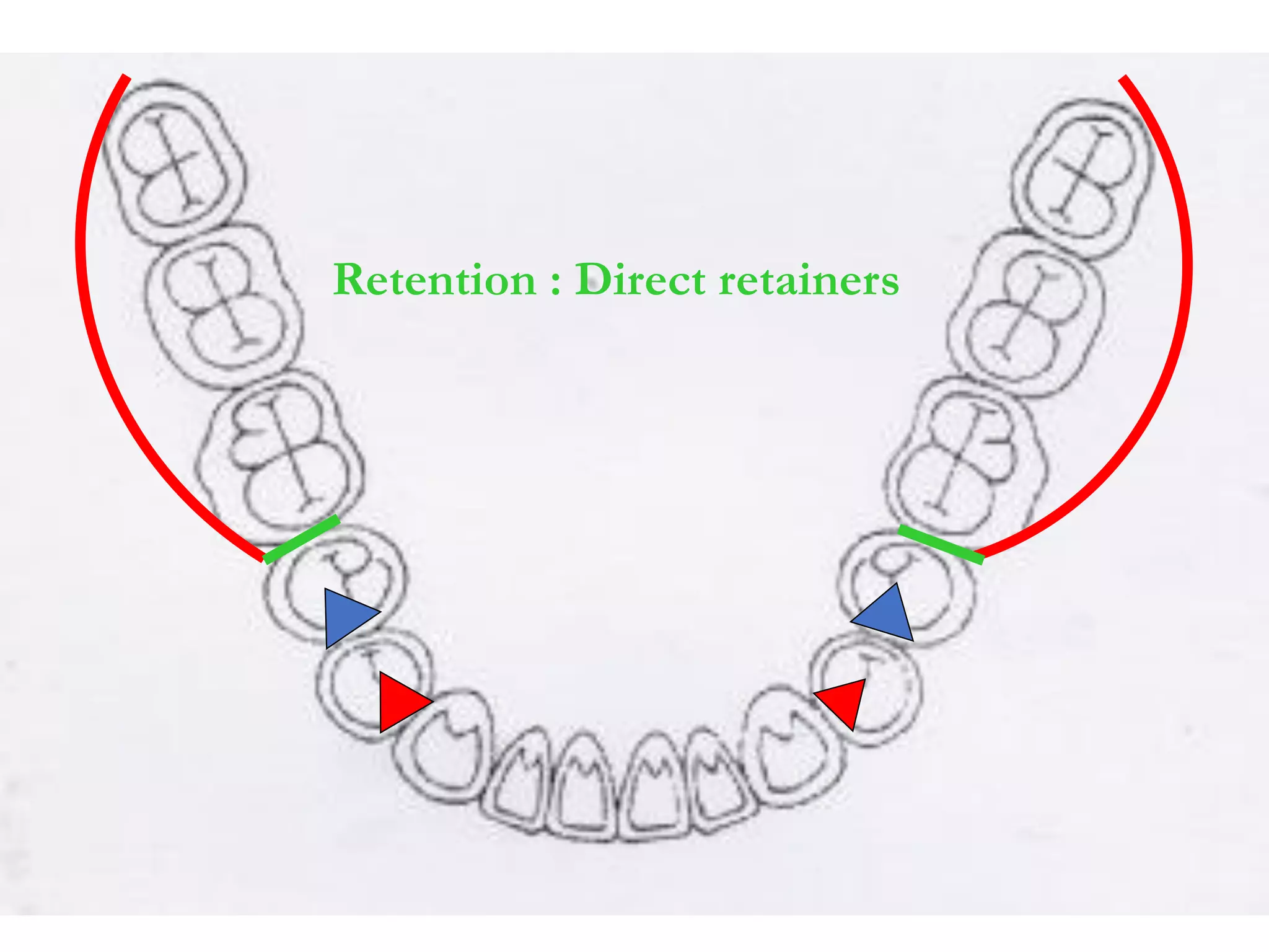 Retention : Direct retainers
 