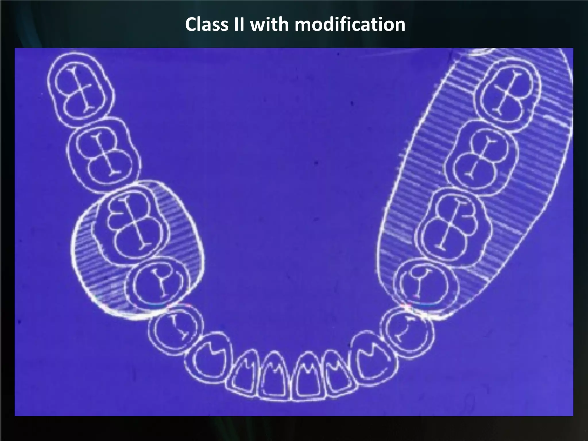 Class II with modification
 