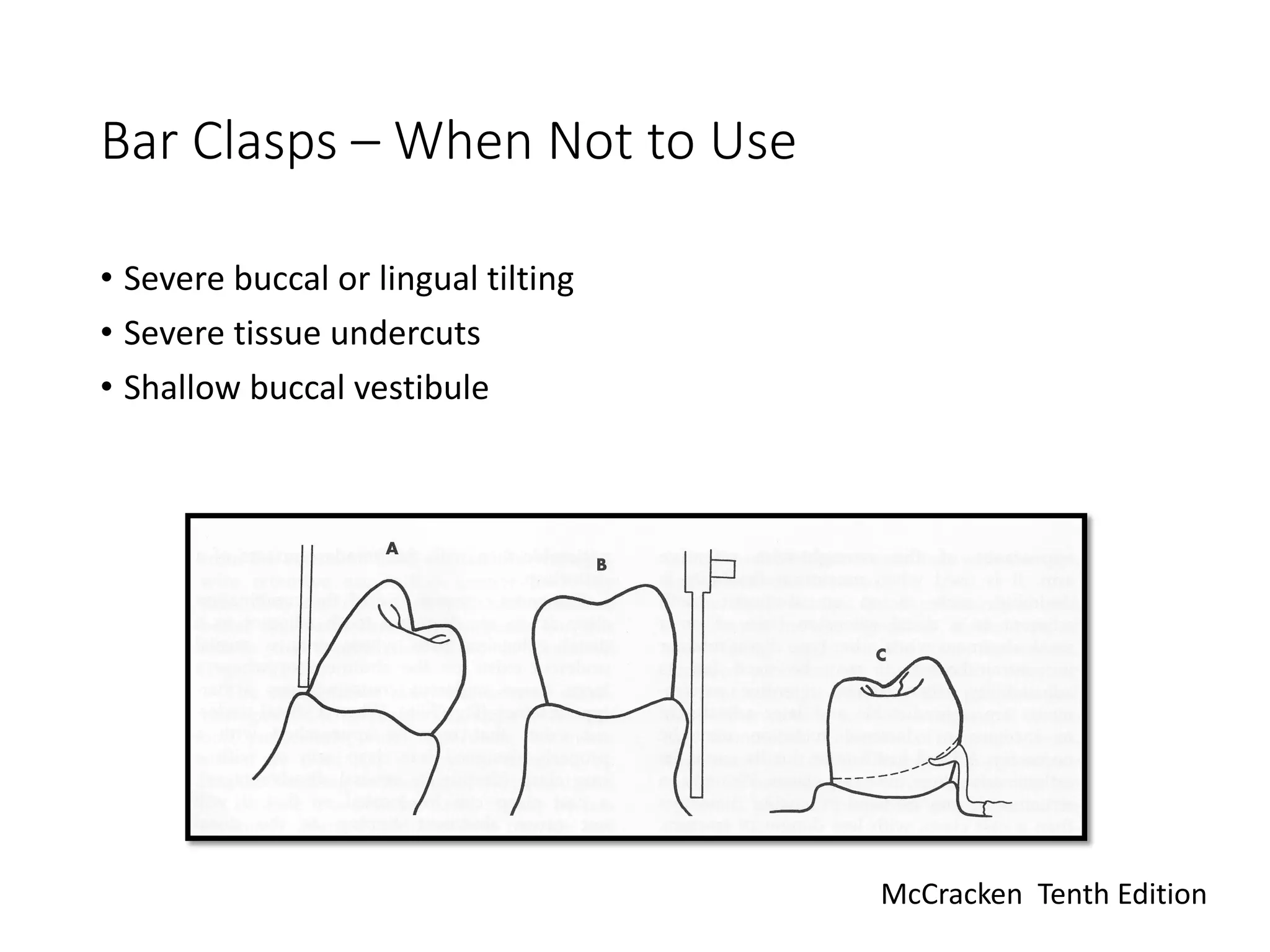 Bar Clasps – When Not to Use
• Severe buccal or lingual tilting
• Severe tissue undercuts
• Shallow buccal vestibule
McCracken Tenth Edition
 
