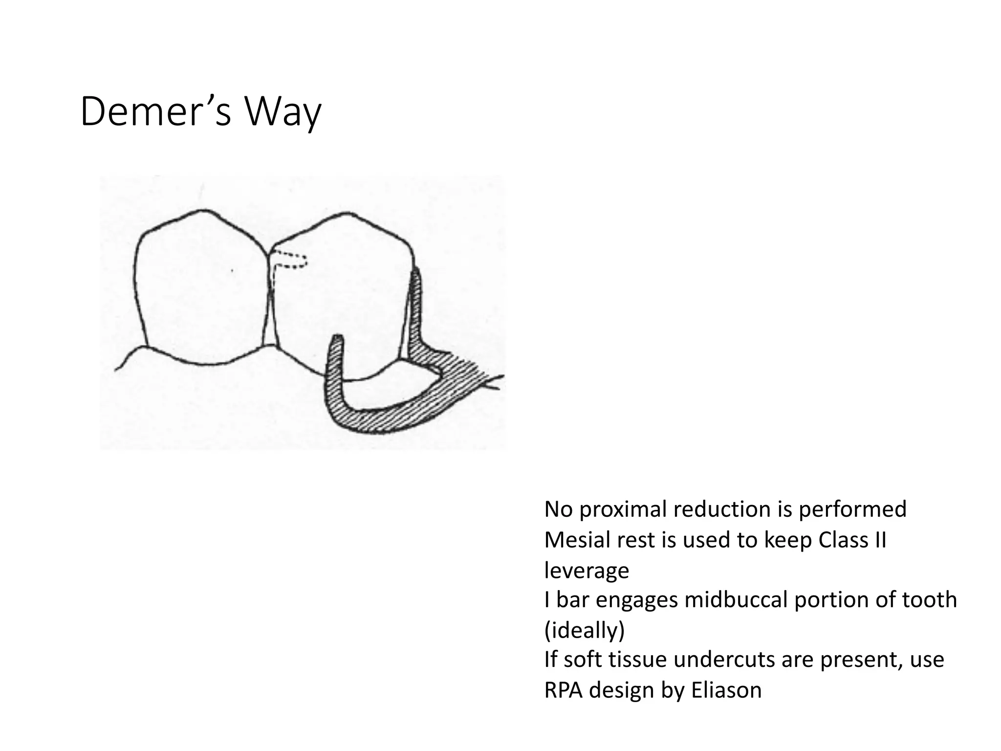 Demer’s Way
No proximal reduction is performed
Mesial rest is used to keep Class II
leverage
I bar engages midbuccal portion of tooth
(ideally)
If soft tissue undercuts are present, use
RPA design by Eliason
 