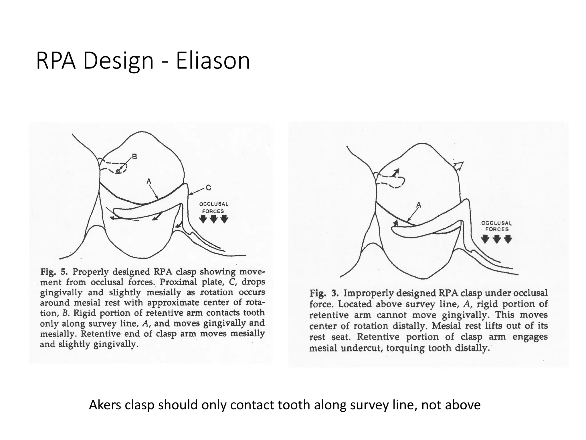 RPA Design - Eliason
Akers clasp should only contact tooth along survey line, not above
 