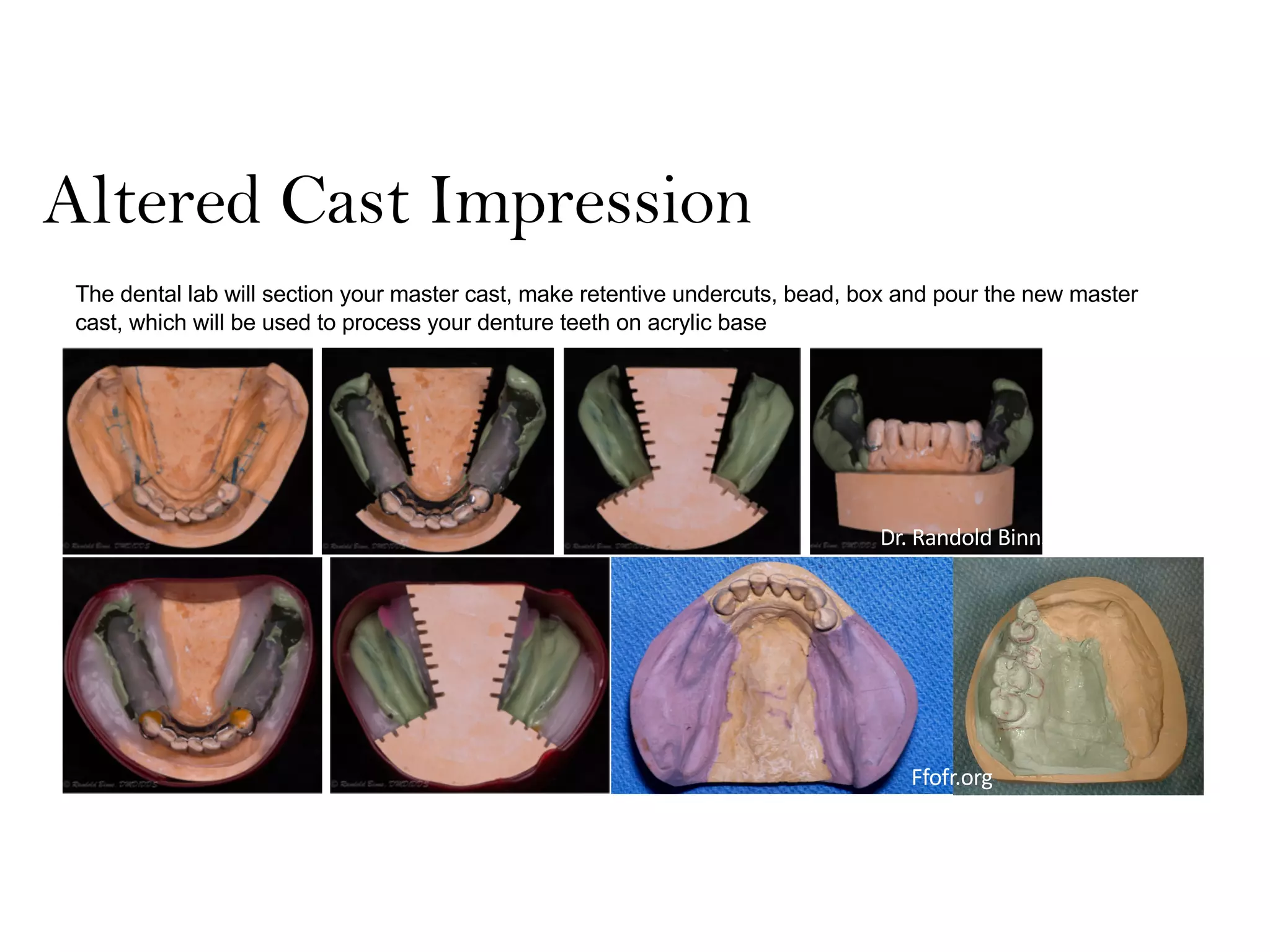 Altered Cast Impression
The dental lab will section your master cast, make retentive undercuts, bead, box and pour the new master
cast, which will be used to process your denture teeth on acrylic base
Dr. Randold Binns
Ffofr.org
 