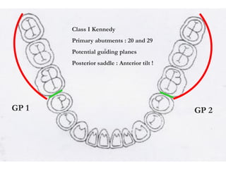 Guide Plane Rpd Continous Basic Principles of RPD design I & II.pdf