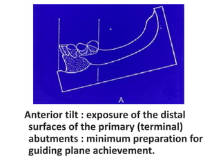 Basic Principles of RPD design I & II.pdf