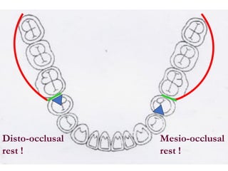 Mesial Rest Rpd Basic Principles of RPD design I & II.pdf
