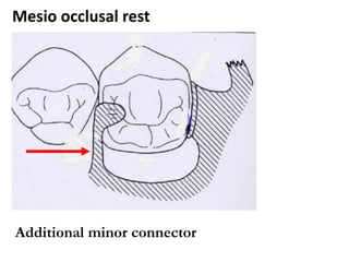 Mesial Rest Rpd Basic Principles of RPD design I & II.pdf