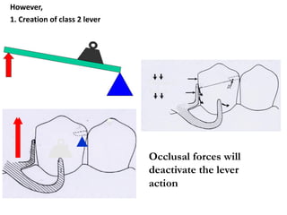 Lever System Rpd Basic Principles of RPD design I & II.pdf