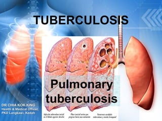 TUBERCULOSIS
Pulmonary
tuberculosisDR CHIA KOK KINGDR CHIA KOK KING
Health & Medical OfficerHealth & Medical Officer
PKD Langkawi, KedahPKD Langkawi, Kedah
 