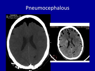 Pneumocranium Radiograph Basic radiology for non radiologist | PPTX