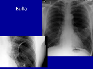 • Simple pneumothorax. The right lung edge is
faintly visible on the inspiratory film. However,
the pneumothorax becomes c...
