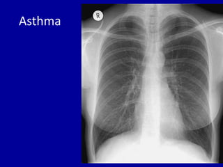Tension pneumothorax
 