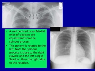 • A well centred x-ray. Medial
ends of clavicles are
equidistant from the
spinous process.
• This patient is rotated to th...