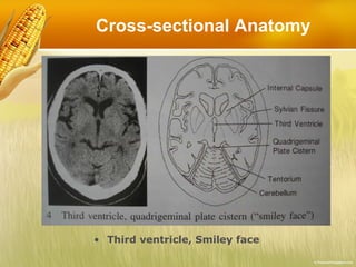 Cross-sectional Anatomy Third ventricle, Smiley face 
