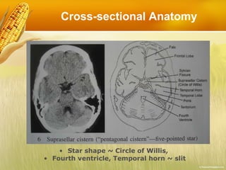 Cross-sectional Anatomy Star shape ~ Circle of Willis,  Fourth ventricle, Temporal horn ~ slit 