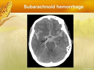 Subarachnoid hemorrhage 