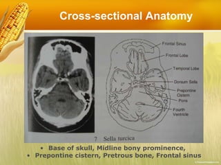 Cross-sectional Anatomy Base of skull, Midline bony prominence,  Prepontine cistern, Pretrous bone, Frontal sinus 