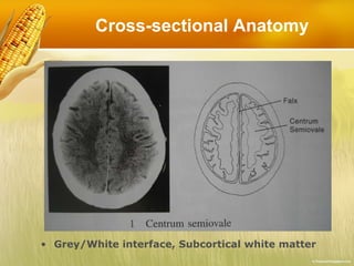 Cross-sectional Anatomy Grey/White interface, Subcortical white matter 