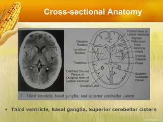 Cross-sectional Anatomy Third ventricle, Basal ganglia, Superior cerebellar cistern 