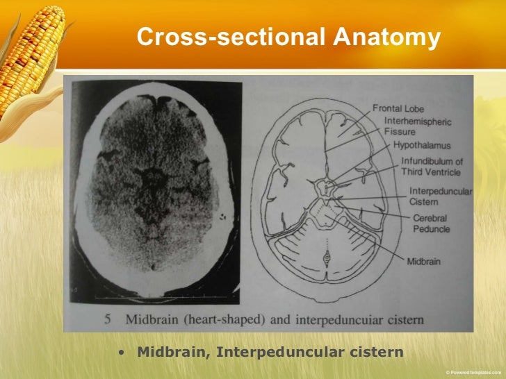 Basic reading computed tomography (ct) of brain