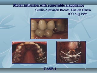 Molar intrusion with removable a applianceMolar intrusion with removable a appliance
Giuilio Alessandri Bonatti, Daniela GiuntaGiuilio Alessandri Bonatti, Daniela Giunta
JCO Aug 1996JCO Aug 1996
CASE 1CASE 1
 