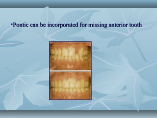 •Pontic can be incorporated for missing anterior toothPontic can be incorporated for missing anterior tooth
 